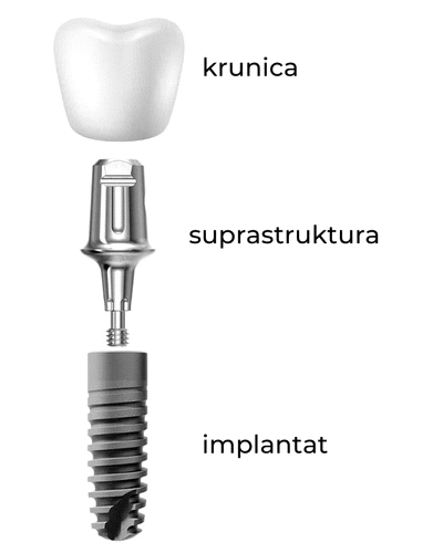 dentalni implantati opis karakteristike